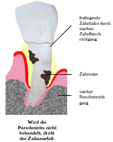 Wird die Parodontitis nicht behandelt, droht Zahnausfall.